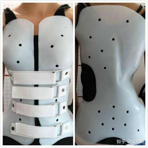 脊柱侧弯佩戴支具越戴越弯案例分享