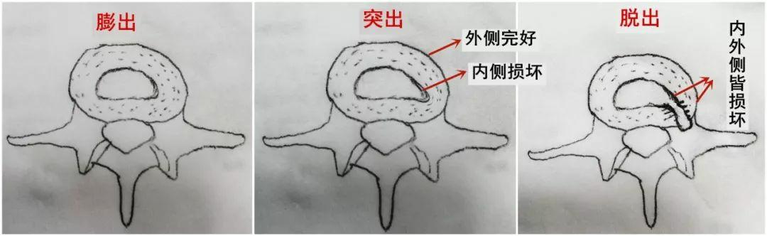 相应的,当纤维环全层都遭到破坏,髓核或含有部分破碎的纤维环及软骨板