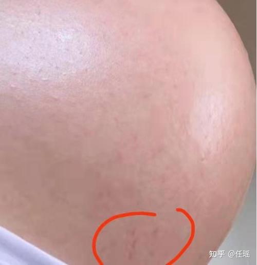 怀孕的时候怎么做可以有效防止或减少妊娠纹