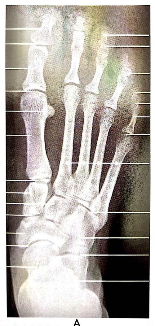 足部x线解剖(足正位片)