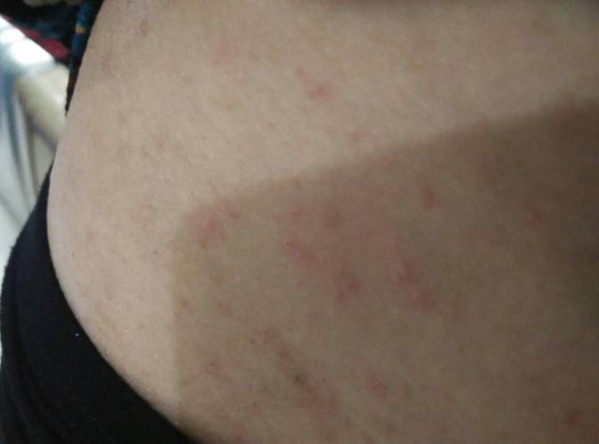 我怀疑自己是不是得了湿疹,从去年冬天到现在身上都还在痒,尤其是晚上