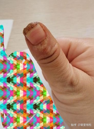 我的甲下疣治疗史