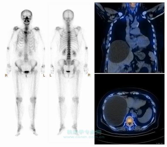 【科普周刊113期】医生,我的骨扫描怎么缺了一大片骨头?