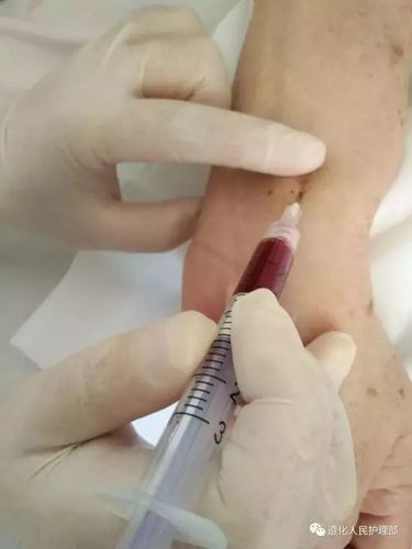 难度较大的桡动脉采血如何做到一针见血