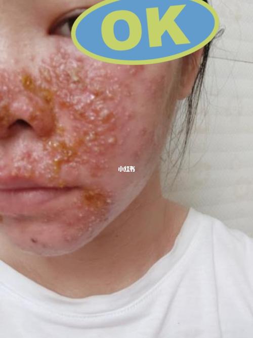 久治不愈,激素脸症状已经出现长期反复,形成面部皮肤范围性细菌感染