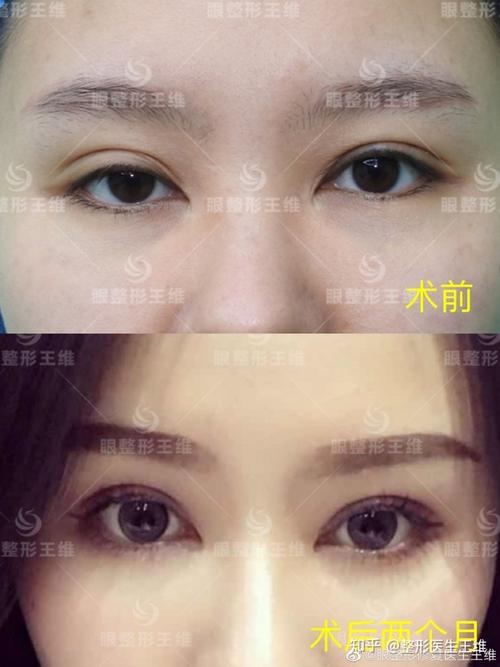 双眼皮不对称怎么改善