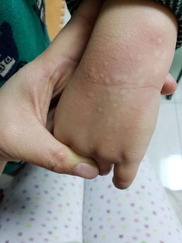 孩子起疹子挠一下就一片,大概5个小时之后又发烧,体温