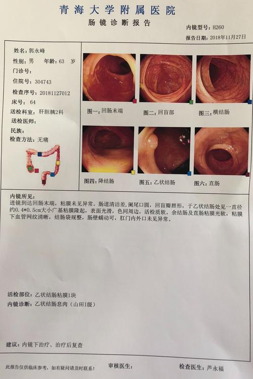 肠镜结果示:乙状结肠息肉(山田i级)肠镜活检:(乙状结肠)管状腺瘤.