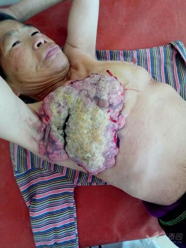 乳腺癌溃烂 [病例帖]