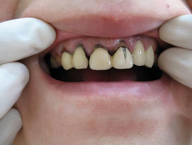 做了烤瓷牙后,里面的基牙可以用多久?基牙龋坏概率高吗?