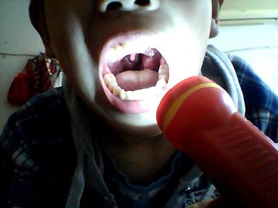 一侧扁桃体明显肿大,呈菜花状,结节状或表面有溃疡,坏死,假膜.