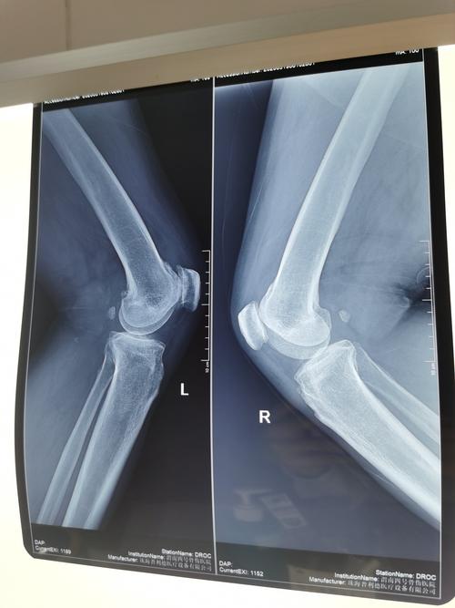 膝关节侧位片:髌骨软化,游离体