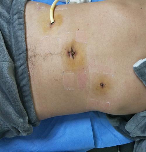 二,腹腔镜胃穿孔修补术优势