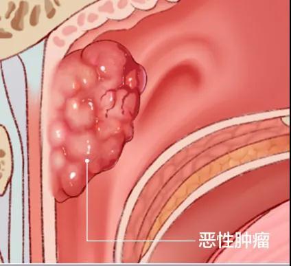 少年脖子长肿包不痛不痒,到成都民生耳鼻喉医院一查竟是鼻咽癌!