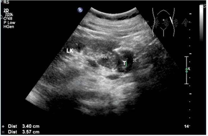 一例后肾腺瘤超声表现病例分析