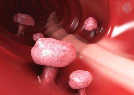 你知道胃息肉吗?不,你不知道!