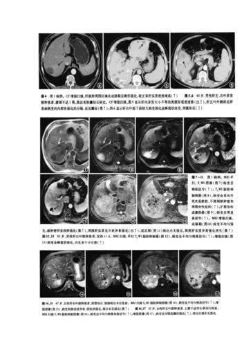 肝脓肿病例影像表现