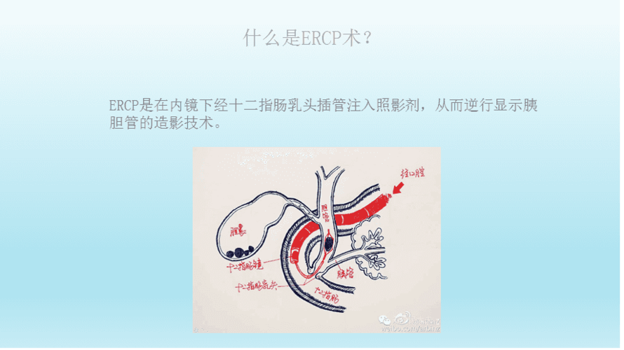 ercp的术后护理ppt课件