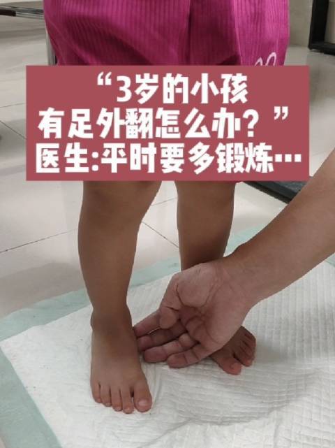 "3岁的小孩有足外翻怎么办?" 医生:平时要多这样锻炼