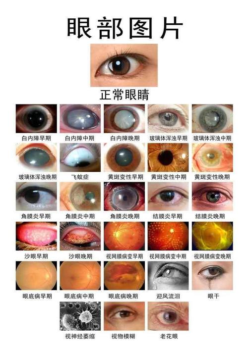 白内障,玻璃体混浊,飞蚊症,视力模糊.不用再往医院跑了