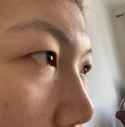 姐妹们我的肿眼泡单眼皮怎么挽救一下