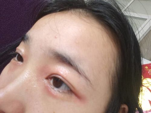 眼睛用化妆品过敏了,刚开始没在意,以为过