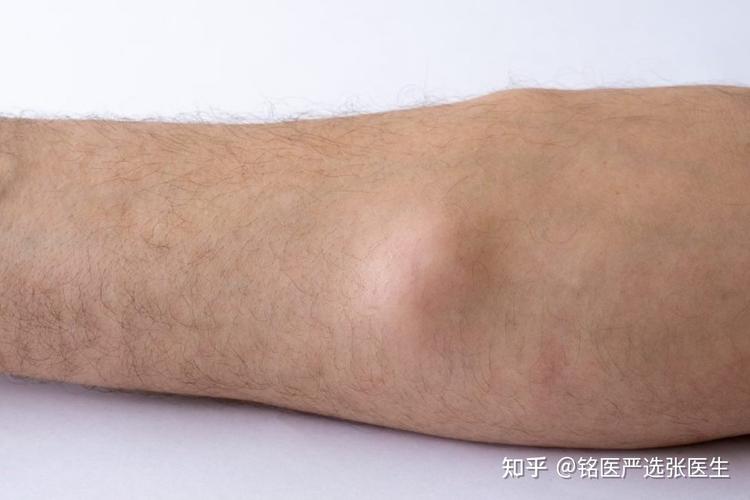 手臂上有很多小疙瘩不痛不痒是不是脂肪瘤