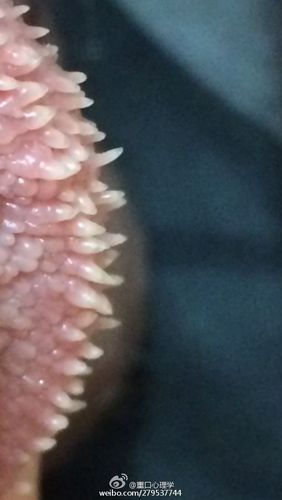 珍珠疹,很多人的私处都有,虽然无害但是影响美观,你们