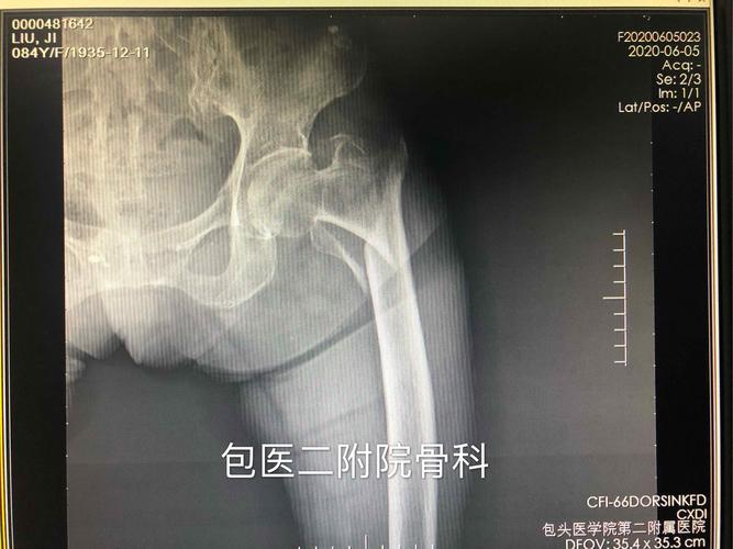 共同完成的人工全髋关节置换术及股骨近端防旋髓内钉内固定术(pfna)