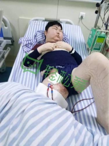 急性肾衰竭,并肺部感染,因激素副作用出现满月脸,水牛背,全缮缁 正文