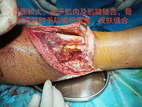 骨一科团队采用皮肤牵张技术,避免大面积取皮及植皮手术,减少患者病痛