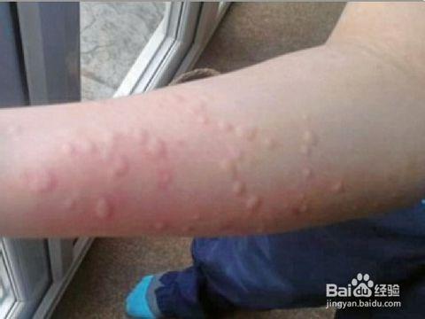 此外,全身症状也不一定就是过敏,也可能是病毒性感染或是其他疾病的