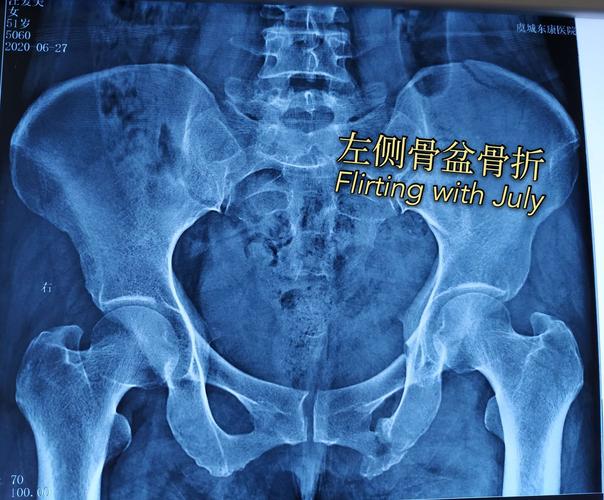 小切口解决重大问题,虞城东康医院骨科首例骨盆骨折耻骨支微创螺钉