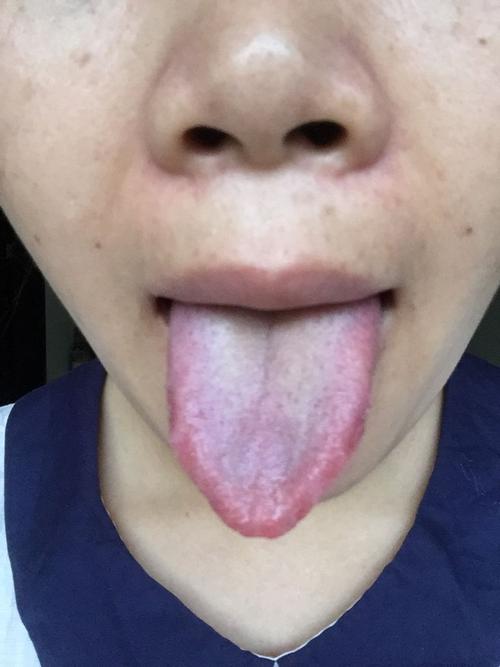 感冒好了后现在咳嗽没好,没痰,干咳,舌尖红,并且有很多红点,舌苔中间