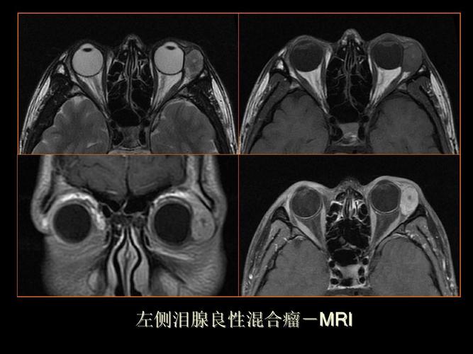 王振常ppt 泪腺 泪腺癌  淋巴增生性病变 特发性炎性假瘤