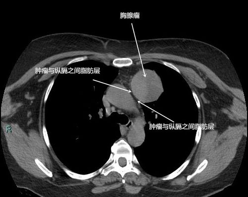 胸腺瘤/前纵隔占位/前纵隔结节/伴有肌无力是癌症吗?