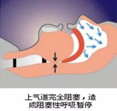 哪些人易患睡眠呼吸暂停综合征?