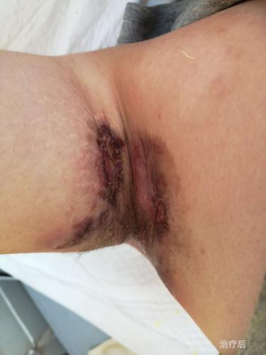 一例化脓性汗腺炎的诊断和治疗