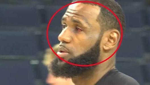 詹姆斯眼睛受伤,视线确实出了问题,今天罚球都不中!