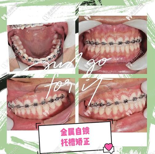 还你笑容,深圳河山口腔龅牙小哥哥戴钢丝牙套的正畸经历