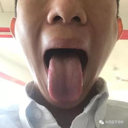 珍贵舌诊:心肾不交,脾湿胃寒,阴虚火旺的舌苔,看完记得存!
