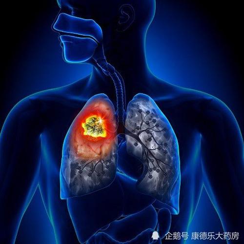 当身体的三处地方出现疼痛时,就需要警惕肺癌的发生!