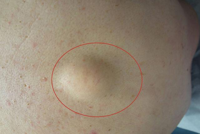 皮肤上长了鼓包,你担心是肿瘤?告诉你医生的判断方法!