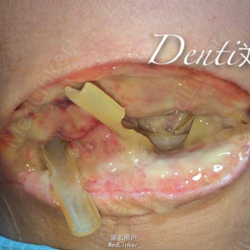 口底多间隙感染术后