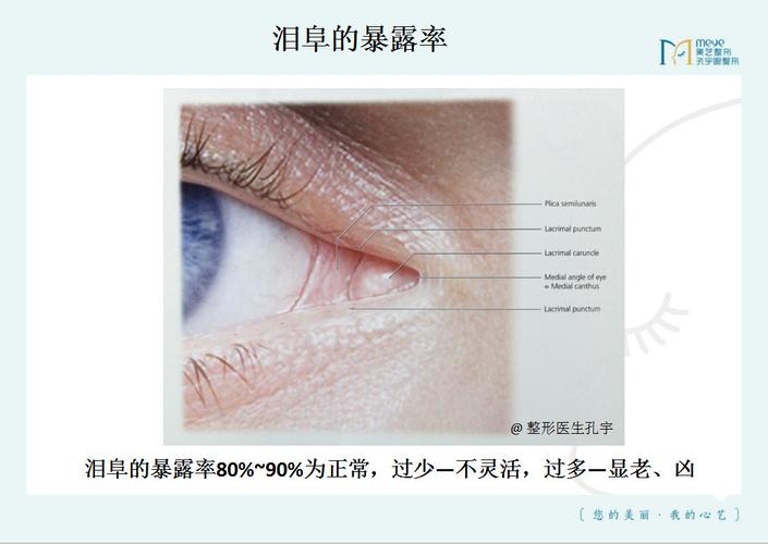 想做双眼皮但是医生说我需要开眼角我不太想开会影响术后的效果吗