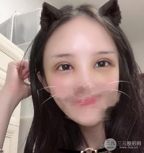 我终于完成了自身很多年的理想,赶到医院门诊干了双眼皮手术,恢复实际