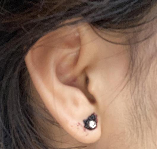 求助|两天前新打的耳洞,只有右耳流血结痂,不知.