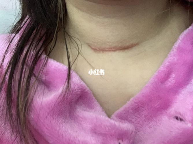 甲状腺手术后伤口更加严重_甲状腺_甲状腺手术_医疗健康_医疗健康其他