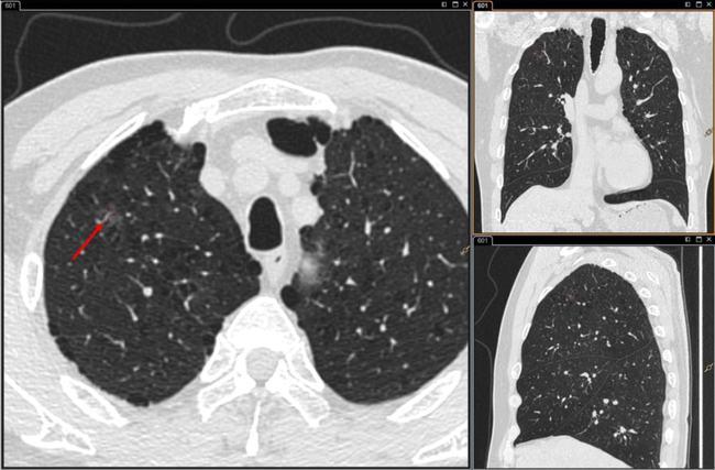ct发现肺磨玻璃结节,怎么办?来听听影像医生怎么说!