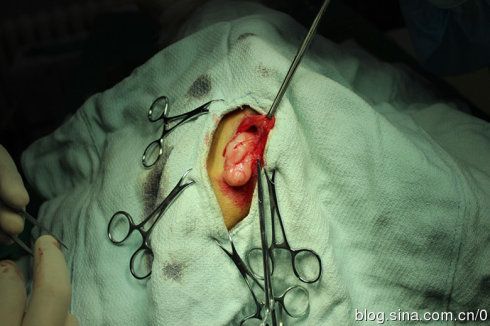 切开后,疝内容物为脂肪,形态为网膜